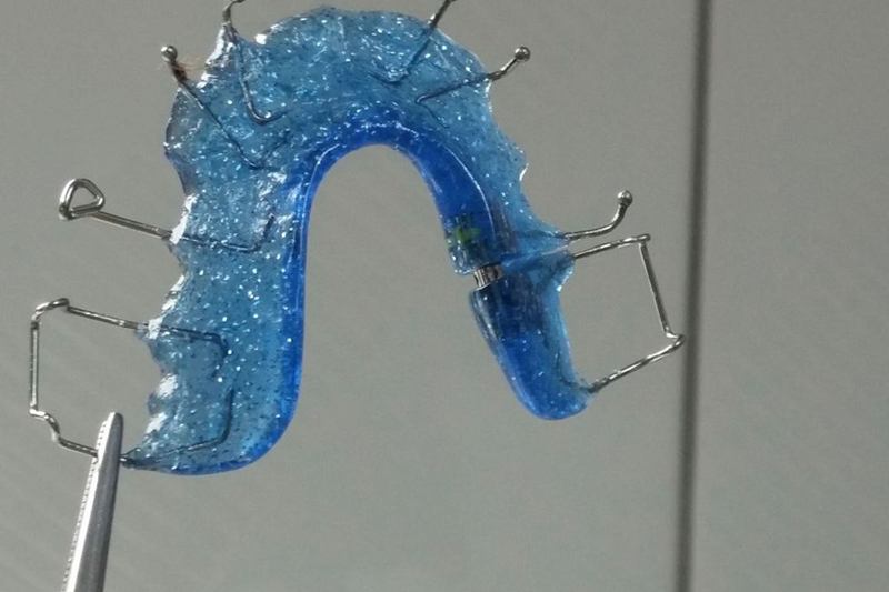 Retenedor dental azul con alambres que hay que limpiar a diario